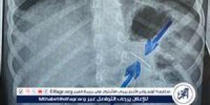 قسم الجراحة..ينجح فى استخراج دبوس من معدة صغير بسوهاج - الهلال الإخباري