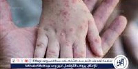 الصحة العالمية تحذر من تفشي جدري القرود في سيراليون - الهلال الإخباري