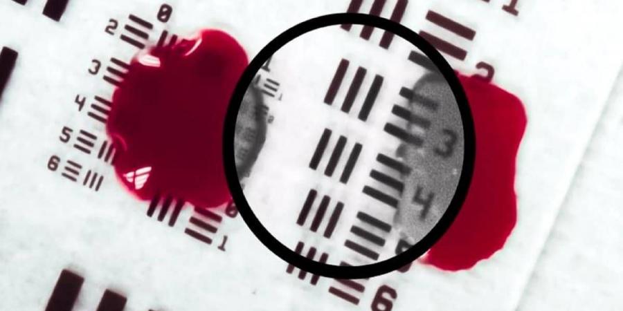 تقنية تجعل الدم شفافاً أثناء الجراحات - الهلال الإخباري